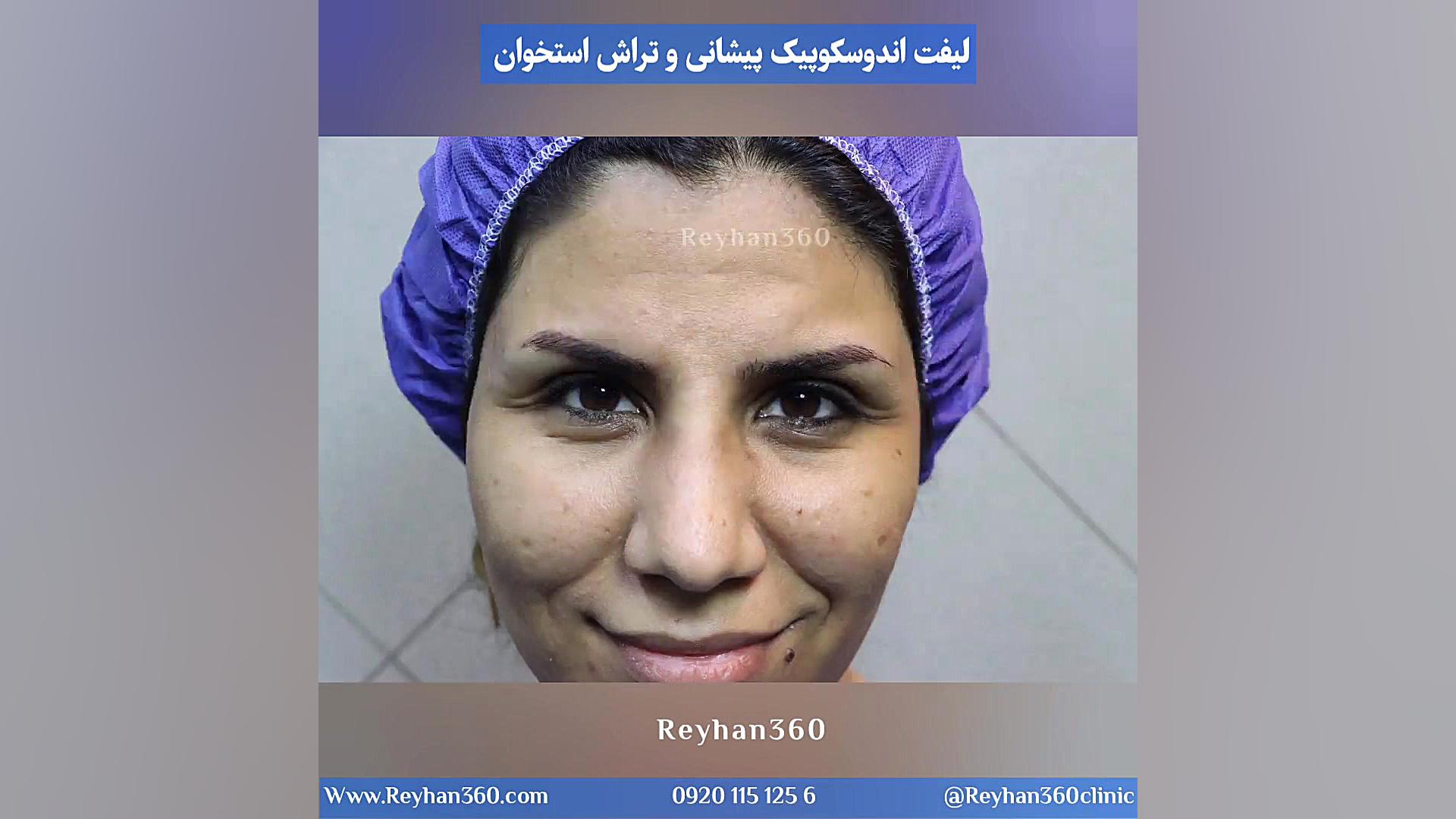 لیفت اندوسکوپیک پیشانی ریحان پوشش زخم هیدروکلوییدی