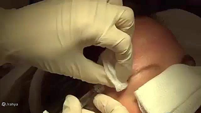 تزریق ژل به پیشانی سیتوژنتیک مولکولی