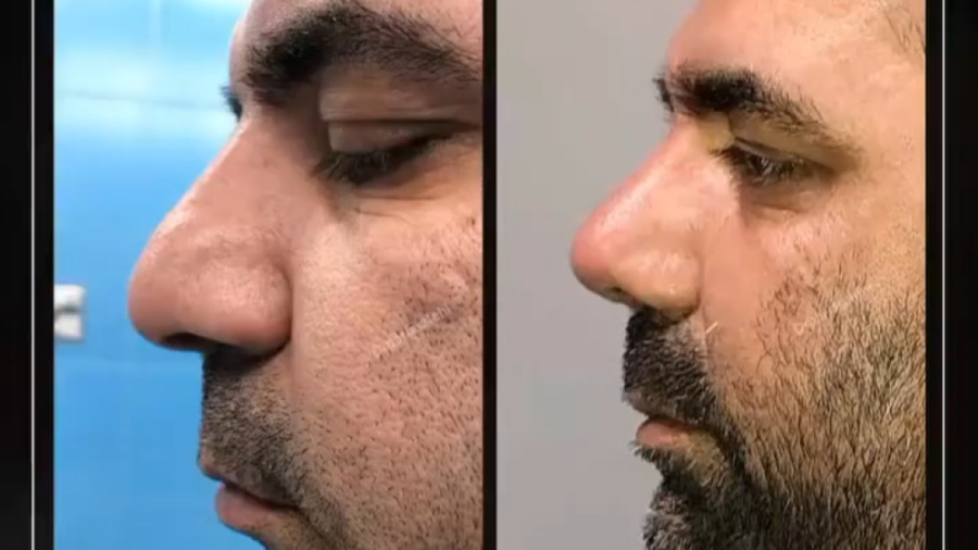 رینوپلاستی در آقایان - دکتر پریا صالحی دکتر پریا صالحی ✔ بهترین جراح بینی تهران