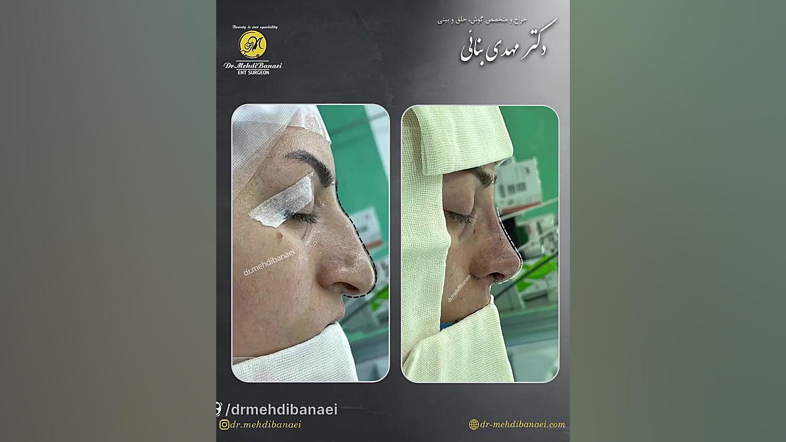 جراحی بینی با افتادگی شدید نوک بینی