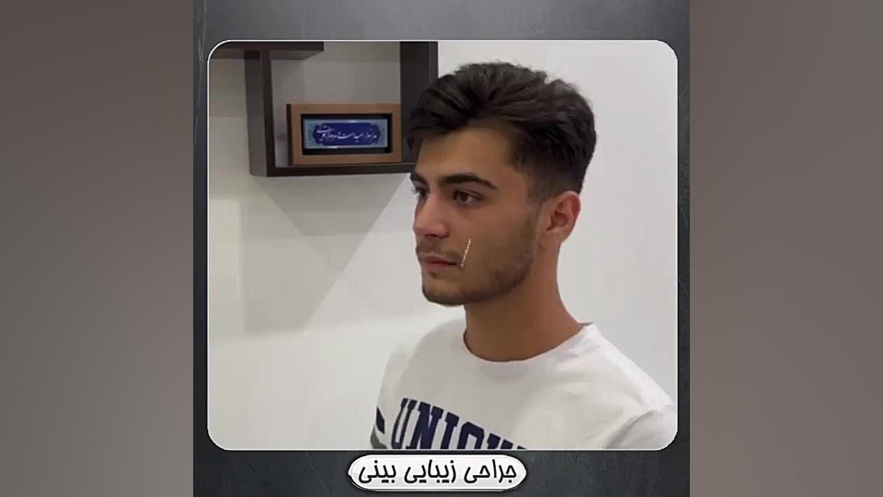 سه ماه بعد از جراحی بینی طبیعی و مردانه