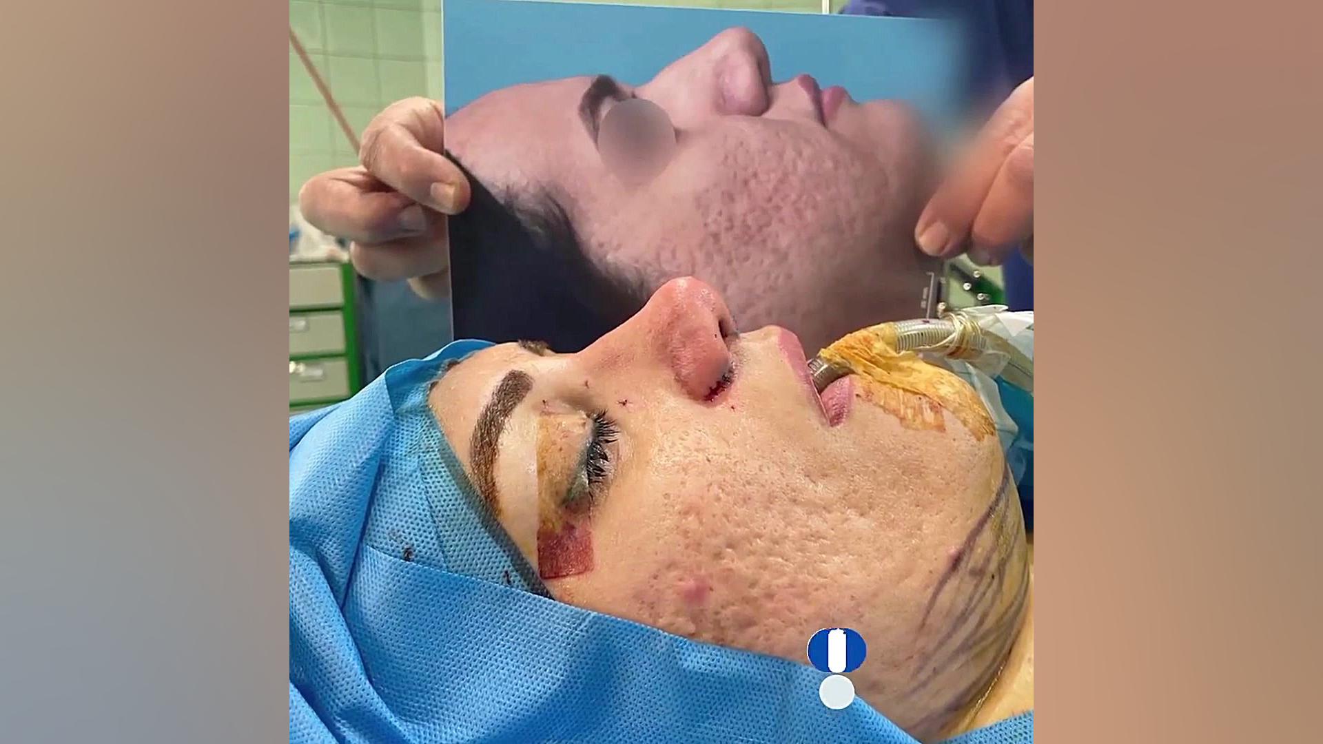 نمونه کار واقعی جراحی بینی دکتر حمید رضا فتحی فوق تخصص جراحی پلاستیک