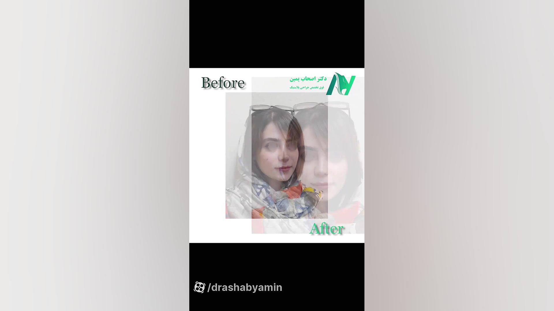 عمل بینی گوشتی دکتر محمودرضا اصحاب یمین - فوق تخصص پلاستیک