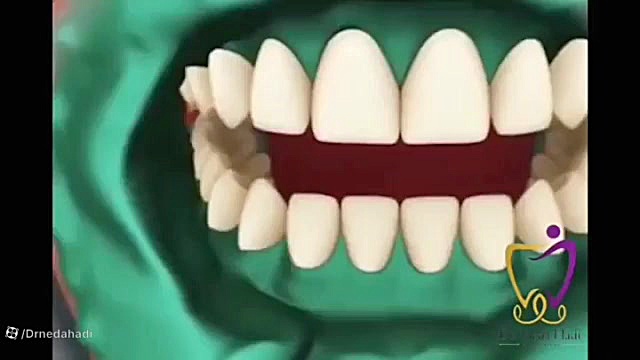 انیمیشن روند بلیچینگ هایپرپاراتیروئیدیسم