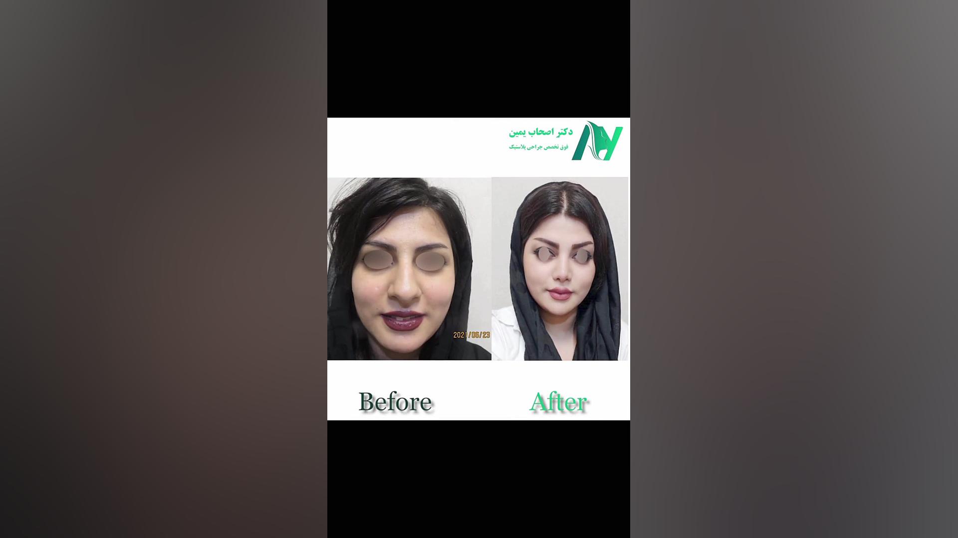 عمل بینی طبیعی دکتر محمودرضا اصحاب یمین - فوق تخصص پلاستیک