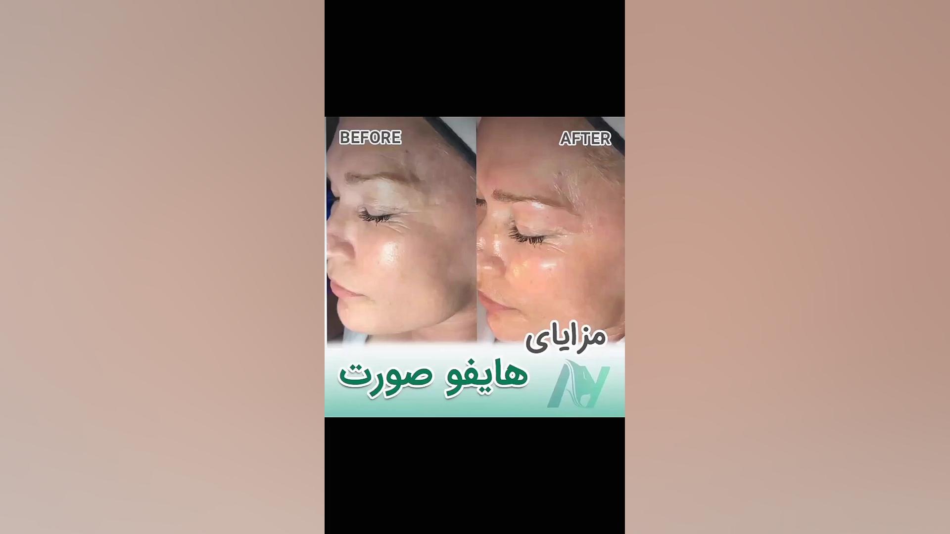 مزایای هایفو صورت دکتر محمودرضا اصحاب یمین - فوق تخصص پلاستیک