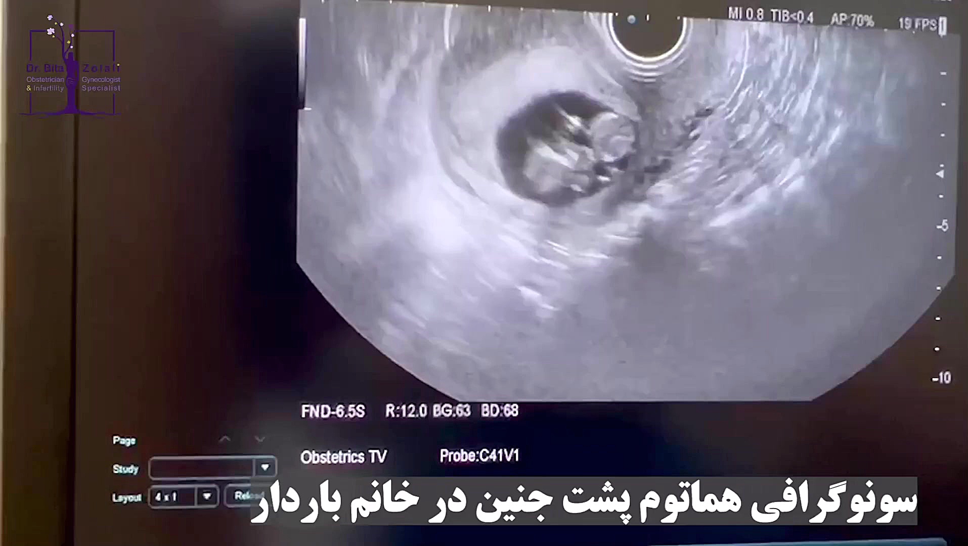 سونوگرافی هماتوم پشت جنین اینستاگرام