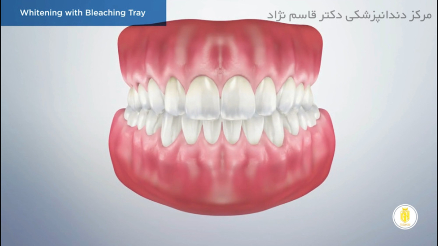 بلیچینگ دندان هایپرپاراتیروئیدیسم