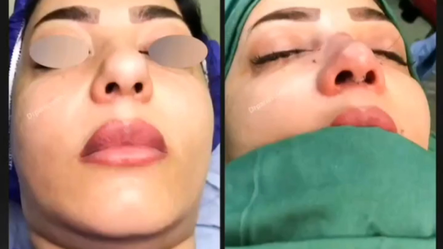 جراحی زیبایی بینی - دکتر پریا صالحی دکتر پریا صالحی ✔ بهترین جراح بینی تهران