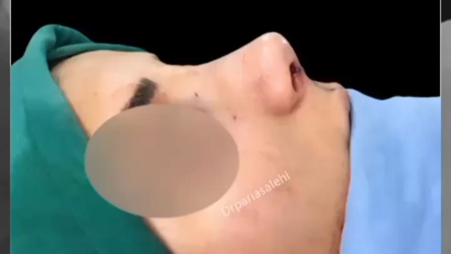 بلافاصله بعد از رینوپلاستی - دکتر پریا صالحی دکتر پریا صالحی ✔ بهترین جراح بینی تهران