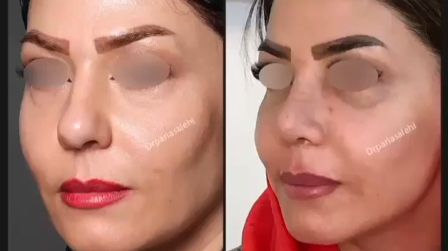 فیلم جراحی زیبایی بینی - دکتر پریا صالحی دکتر پریا صالحی ✔ بهترین جراح بینی تهران