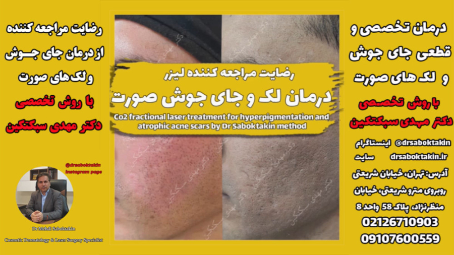 رضایت مراجعه کننده از درمان قطعی جای جوش و لک های صورت با روش دکتر سبکتکین لیفت پیشانی
