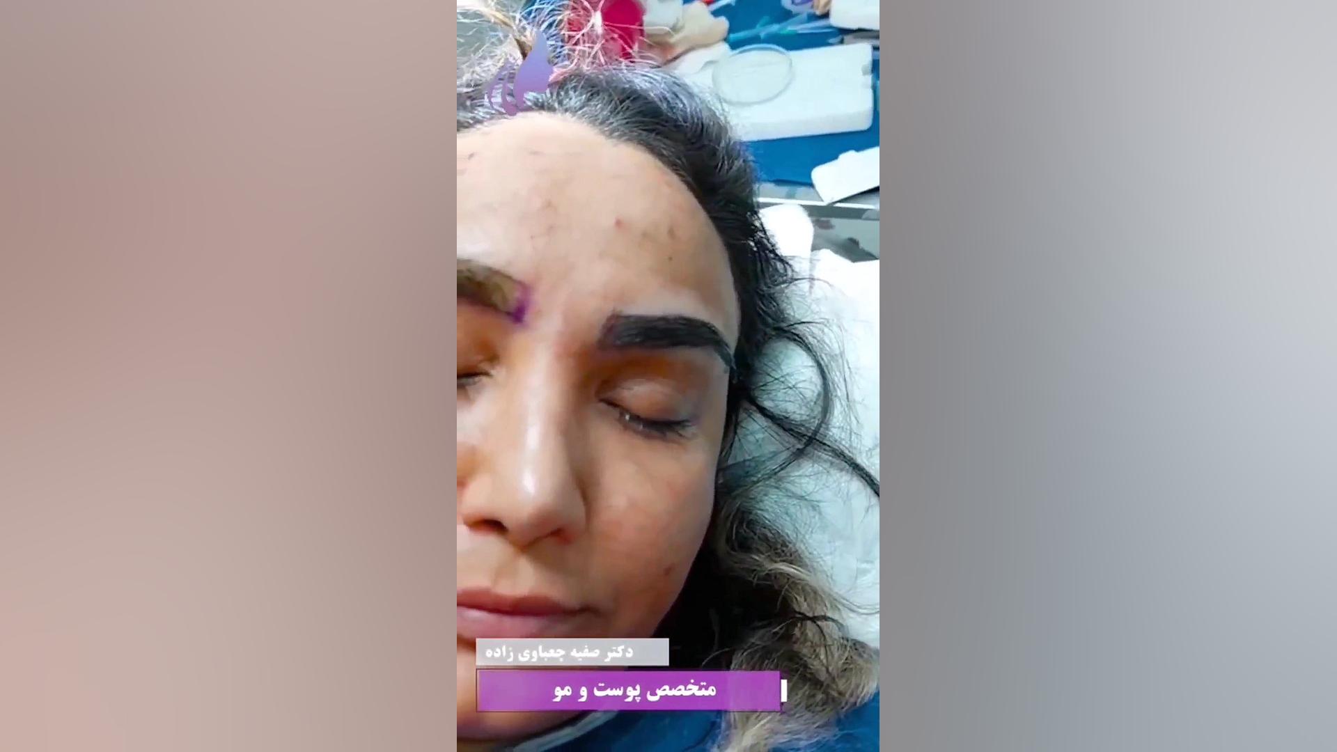 کاشت ابرو پرتراکم دکتر صفیه چعباوی زاده