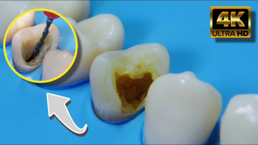 ترمیم دندان پوسیده شده - دندانسازی - پر کردن دندان ها منافذ باز پوست