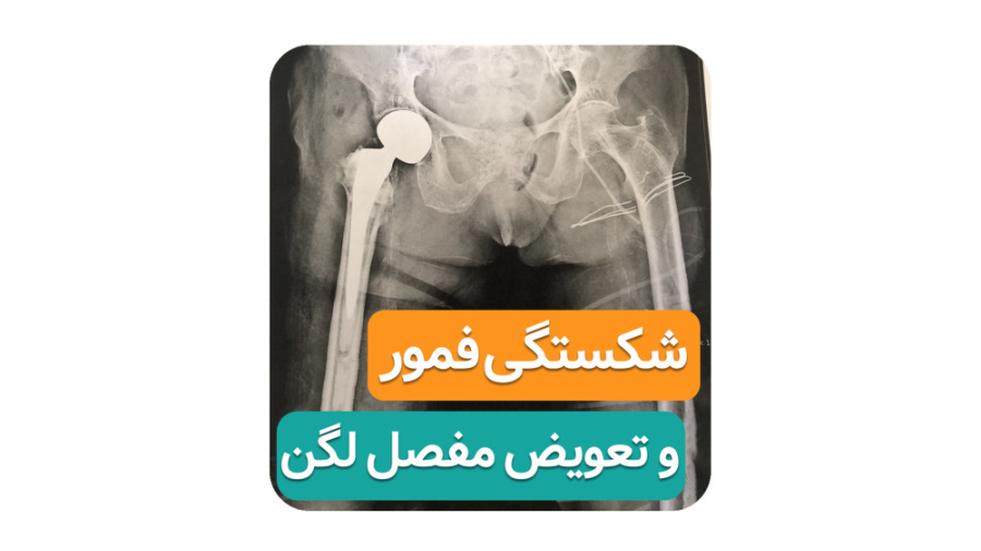 شکستگی گردن فمور و تعویض مفصل لگن ( دکتر محمدرضا صادقی _ جراح ارتوپد ) امیر جدیدی