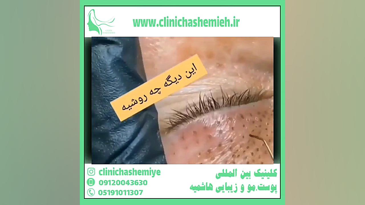 لیفت چشم آزمایش شمارش رتیکولوسیت