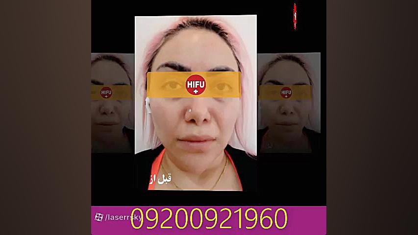 هایفوتراپی با دستگاه دابلو گلد لوسارتان