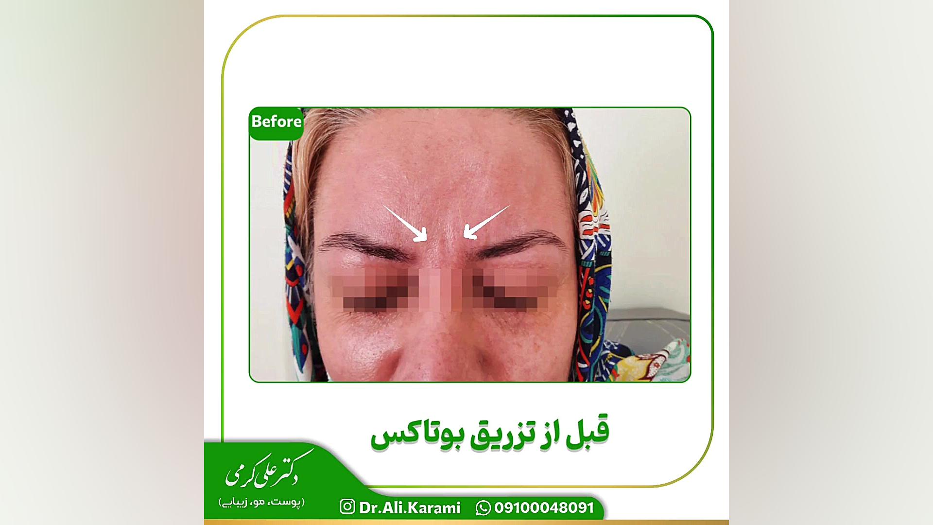 تزریق بوتاکس صورت در کلینیک زیبایی دکتر علی کرمی Synaptic Vesicle Tracking