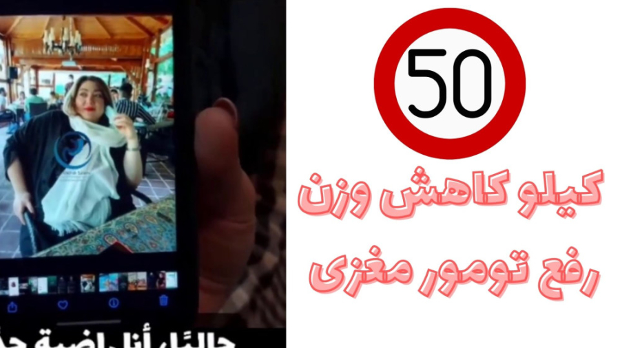 50 کیلو کاهش وزن و رفع تمور مغزی بعد از جراحی چاقی پروتز سینه