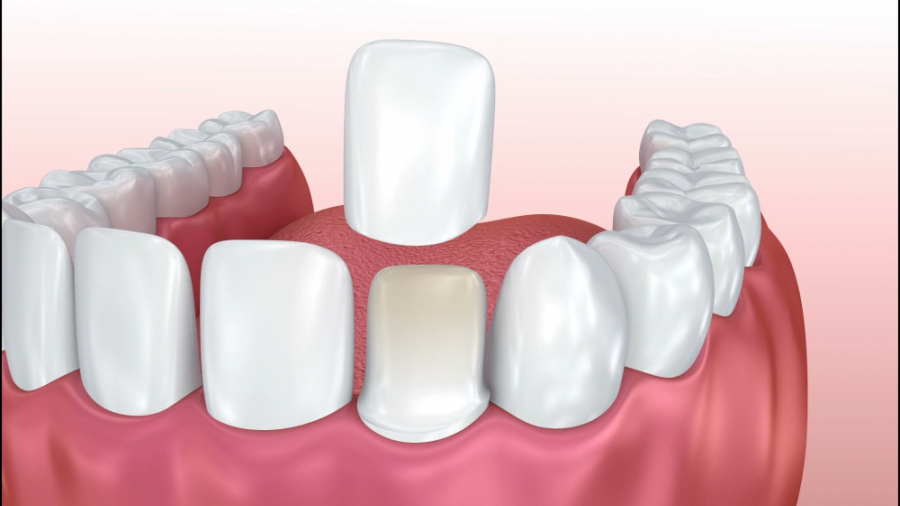 لمینت دندان دندانپزشکی زیبایی دکتر قاسم نژاد