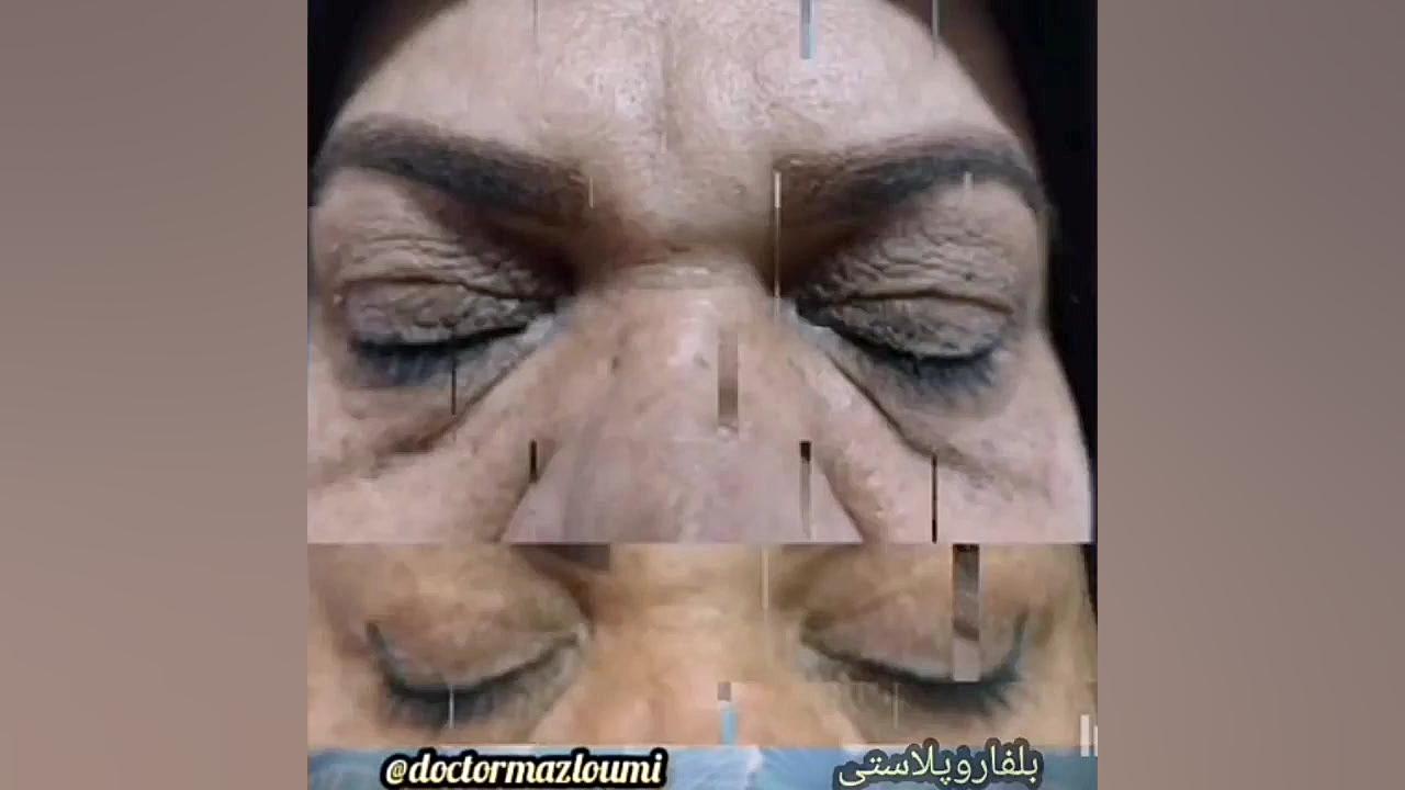 بلفاروپلاستی با دکتر سید حسن مظلومی HIDA Scan