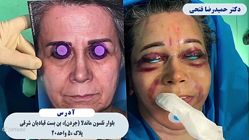 جراحی فیس لیفت کامل دکتر حمید رضا فتحی فوق تخصص جراحی پلاستیک