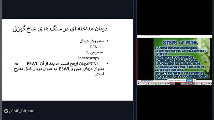 درمانهای مداخله ای در سنگ های کلیه و حالب اکستنشن تاج دندان