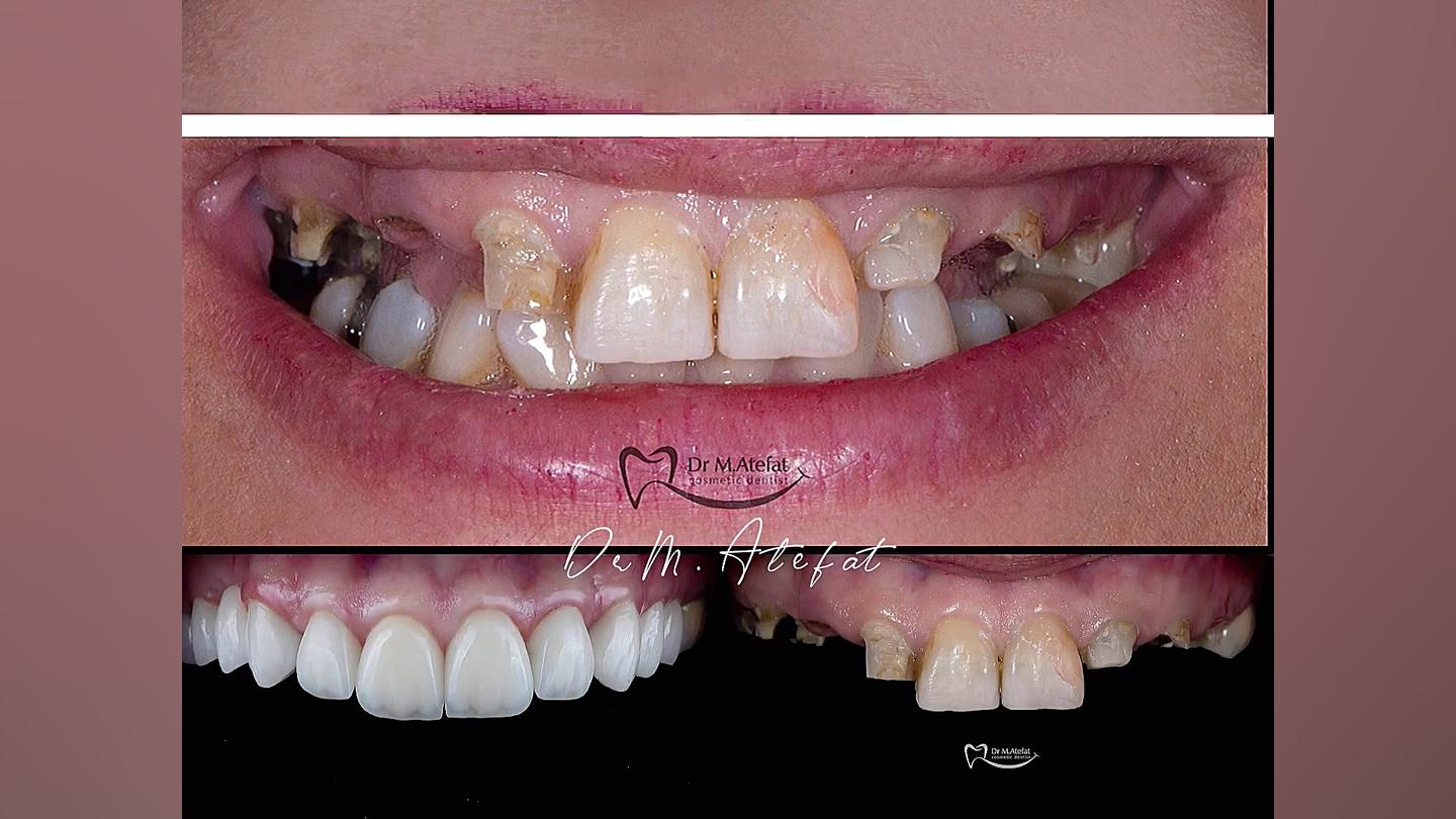 درمان ترکیبی ایمپلنت و روکش های سرامیکی در اصفهان | دکتر محمد عاطفت دکتر محمد عاطفت متخصص ترمیمی و زیبایی اصفهان