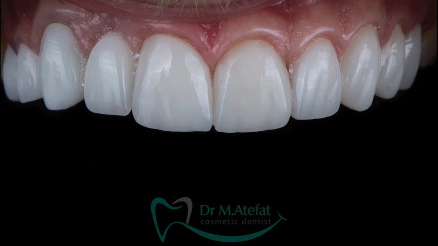 ترکیبی از روکش، ایمپلنت و لمینیت سرامیکی در اصفهان | دکتر محمد عاطفت دکتر محمد عاطفت متخصص ترمیمی و زیبایی اصفهان