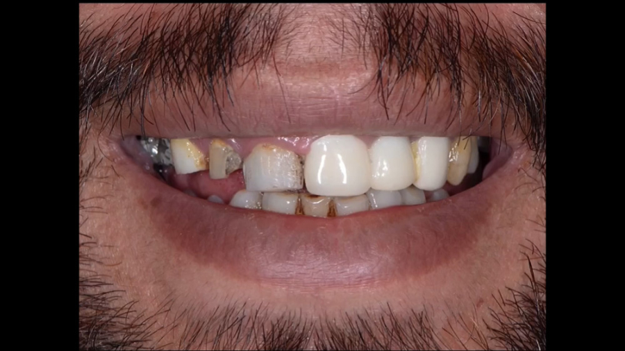 ترکیبی از روکش و لمینیت سرامیکی در اصفهان | دکتر محمد عاطفت دکتر محمد عاطفت متخصص ترمیمی و زیبایی اصفهان