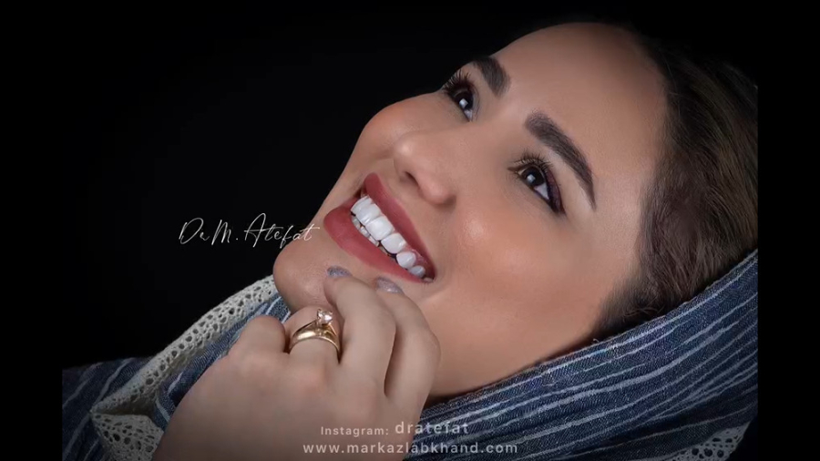 ونیر کامپوزیت فک بالا در اصفهان | دکتر محمد عاطفت دکتر محمد عاطفت متخصص ترمیمی و زیبایی اصفهان