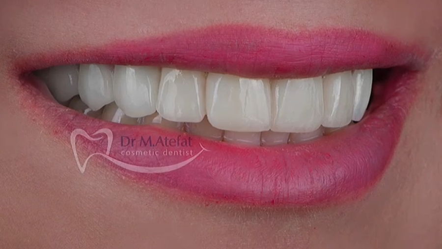 ترکیبی از روکش و لمینیت سرامیکی در اصفهان | دکتر محمد عاطفت در اصفهان دکتر محمد عاطفت متخصص ترمیمی و زیبایی اصفهان