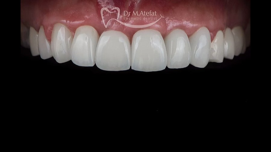 ترکیبی از ایمپلنت ، روکش و لمینیت سرامیکی در اصفهان | دکتر محمد عاطفت دکتر محمد عاطفت متخصص ترمیمی و زیبایی اصفهان