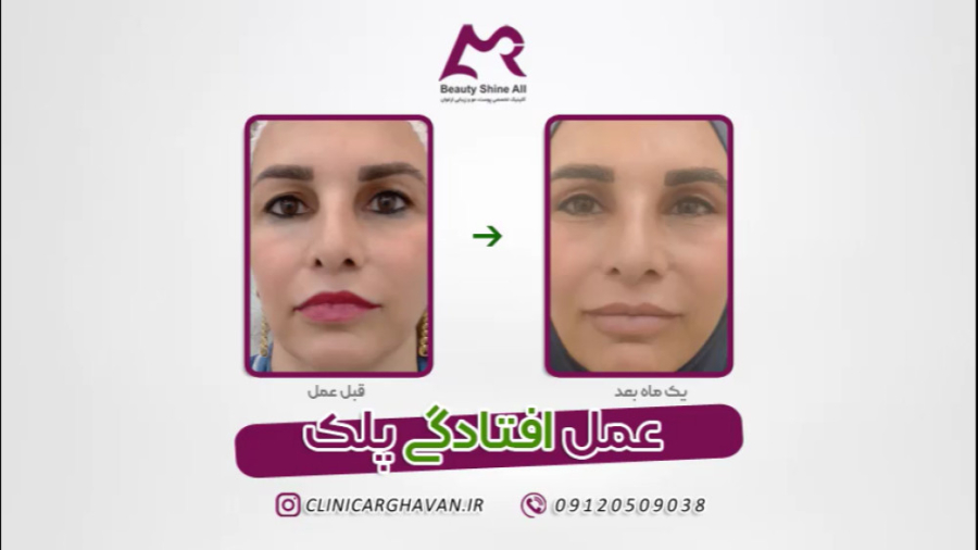 عمل افتادگی پلک - کلینیک پوست و مو ارغوان ساکوبیتریل