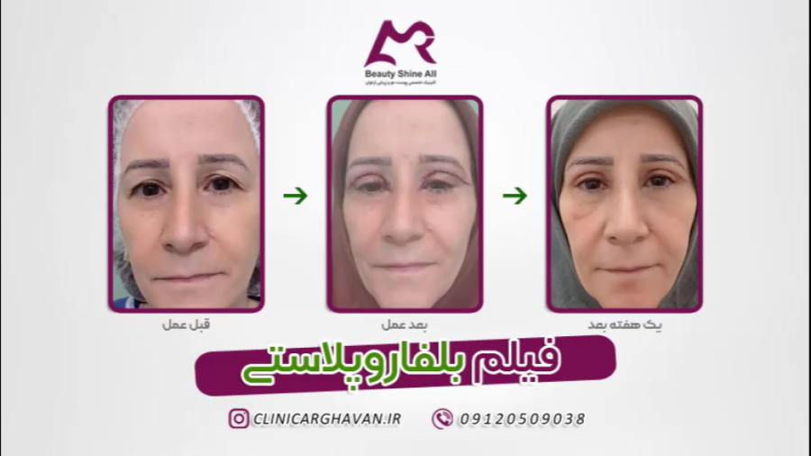 فیلم بلفاروپلاستی - کلینیک پوست و مو ارغوان وزارتان