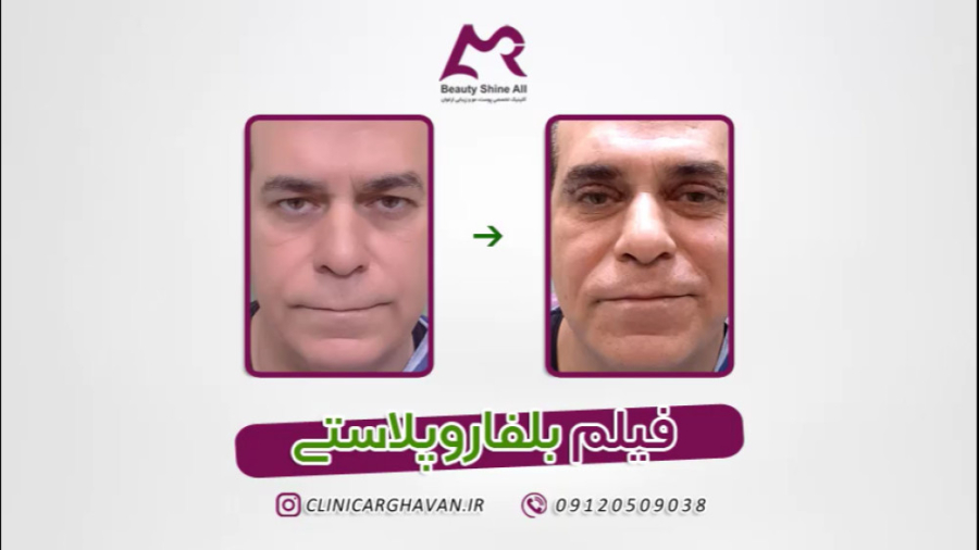 فیلم عمل بلفاروپلاستی - کلینیک پوست و مو ارغوان نپتوکلیب