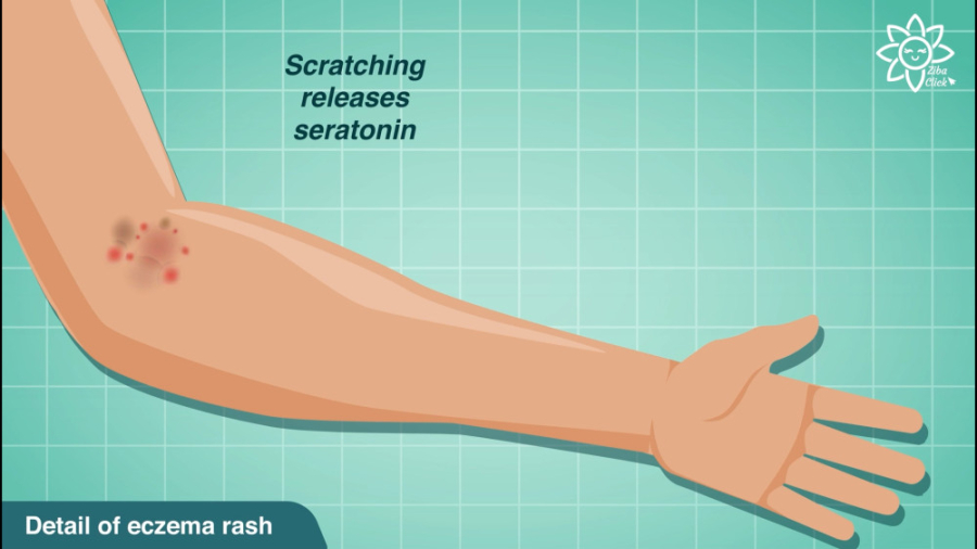 تفاوت ها و شباهت های اگزما و پسوریازیس آکنه