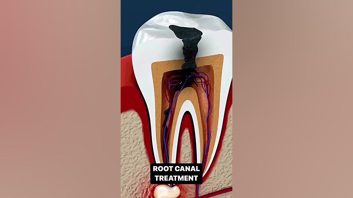فیلم / عصب کشی یا روت کانال دندان/ root canal therapy حمید هیراد