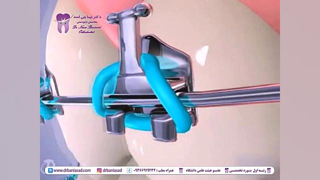 نحوه استفاده از مسواک بین دندانی ارتودنسی _ دکتر بنی اسد دکتر نیما بنی اسد - متخصص ارتودنسی در تهران