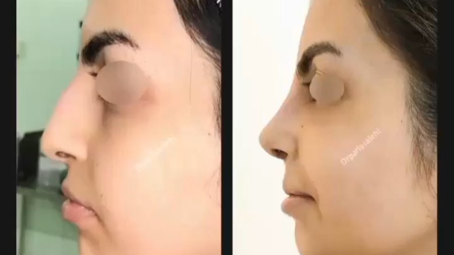جراحی زیبایی بینی - دکتر پریا صالحی دکتر پریا صالحی ✔ بهترین جراح بینی تهران