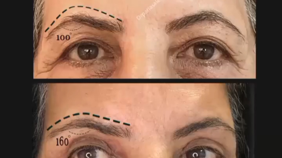 جراحی ترکیبی بلفاروپلاستی - دکتر پریا صالحی دکتر پریا صالحی ✔ بهترین جراح بینی تهران