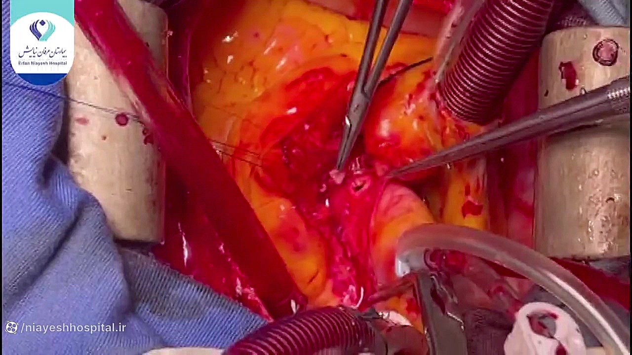 مرکز جراحی قلب - عمل جراحی Malignant course of RCA کلینیک لیزر