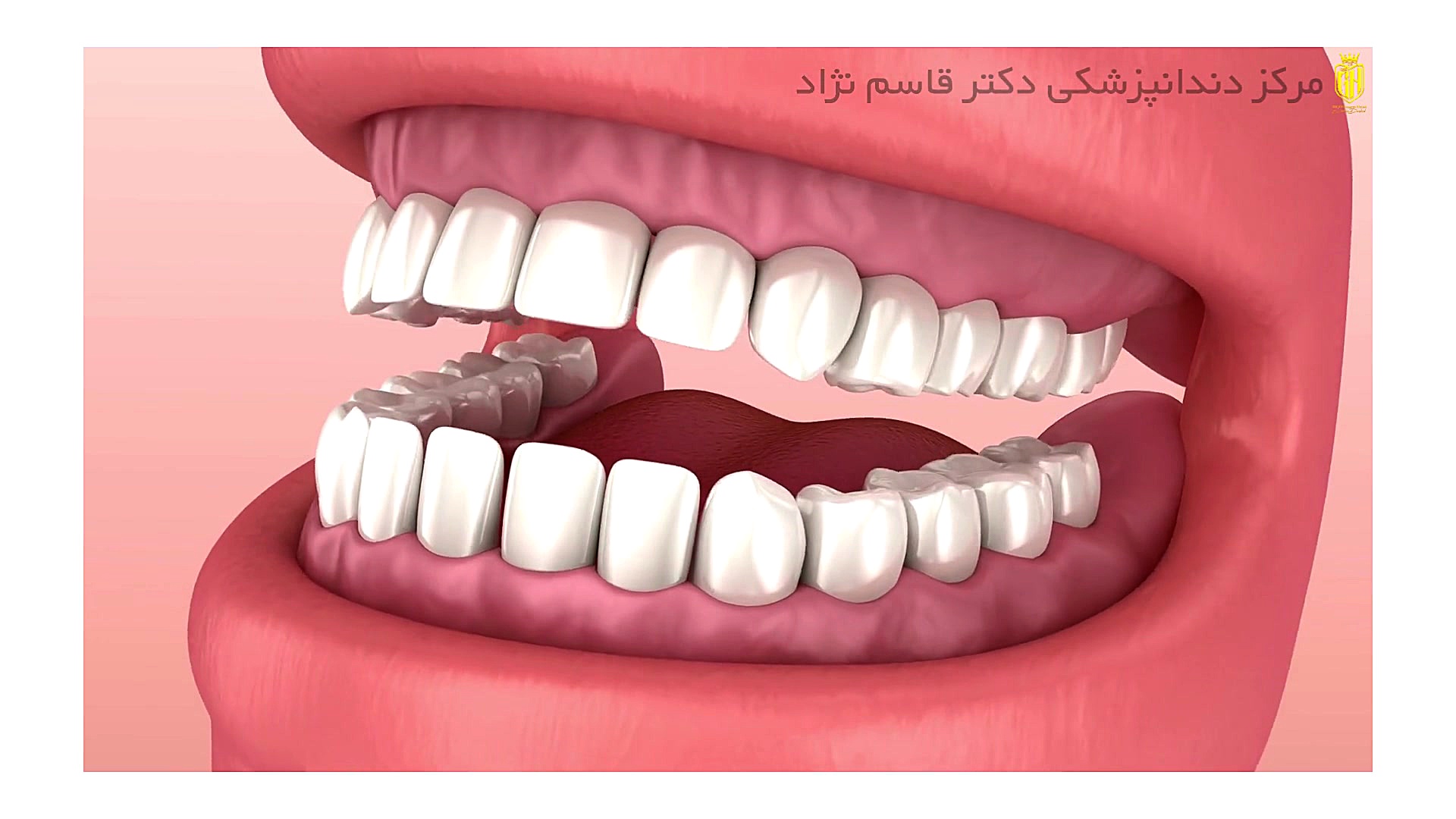 دندان عقل دندانپزشکی زیبایی دکتر قاسم نژاد