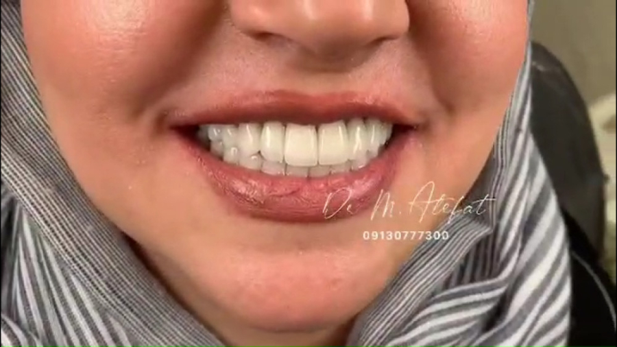 اصلاح طرح لبخند با درمان ترکیبی روکش و لمینیت سرامیکی در اصفهان | دکتر عاطفت دکتر محمد عاطفت متخصص ترمیمی و زیبایی اصفهان