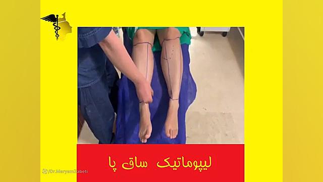 لیپوماتیک ساق پا تست تراشه ژنی