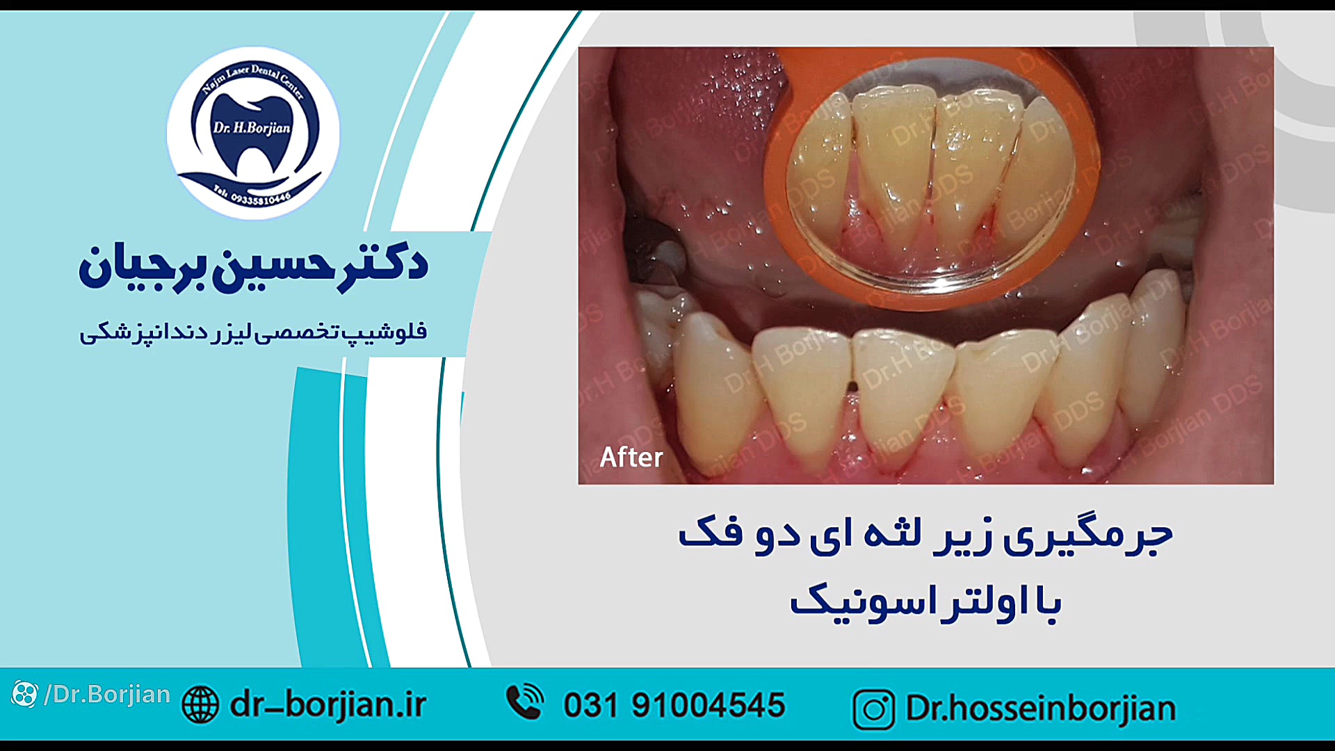 جرمگیری زیر لثه ای دو فک (10) | بهترین جراح لثه اصفهان بیماری تاکایاسو