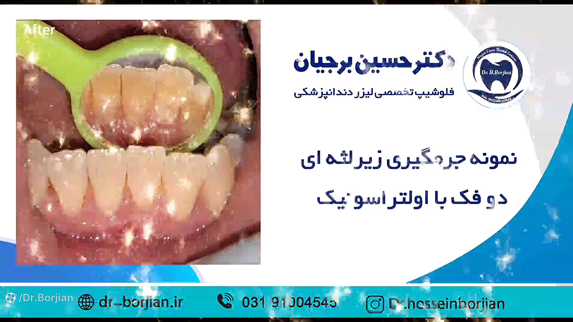 جرمگیری زیر لثه ای دو فک ( 11 ) | بهترین دندانپزشک زیبایی اصفهان Axon Guidance Study