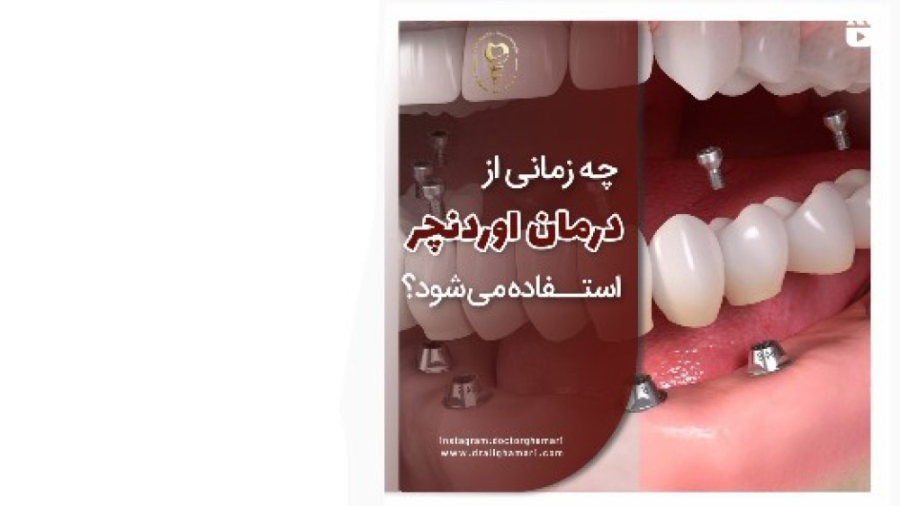 ️چه زمانی از درمان اوردنچر استفاده می شود؟؟️ دکتر علی قمری - متخصص جراحی لثه و ایمپلنت