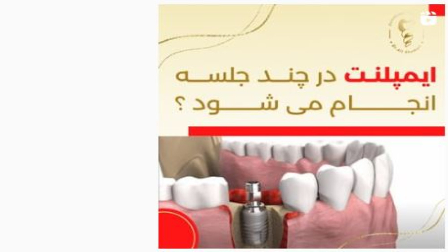 ایمپلنت در چند جلسه انجام می شود؟؟ دکتر علی قمری - متخصص جراحی لثه و ایمپلنت