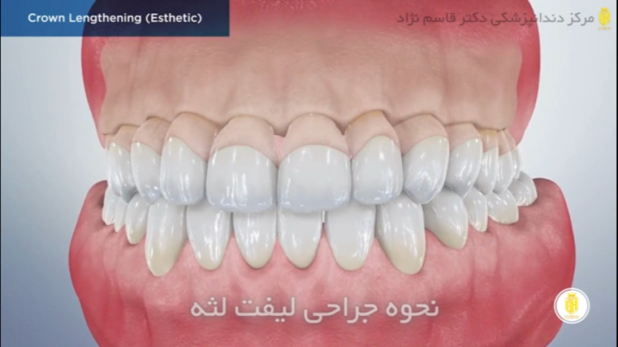 لیفت لثه دندانپزشکی زیبایی دکتر قاسم نژاد